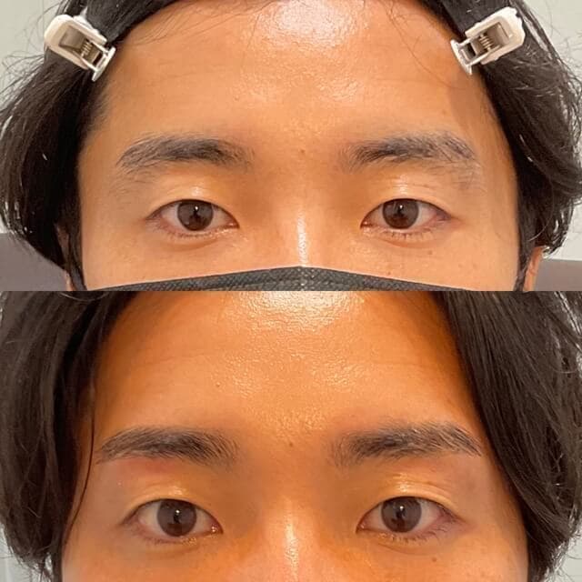 眉毛施術のビフォーアフター